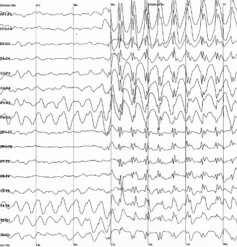 Artifact Removal in EEG Signals